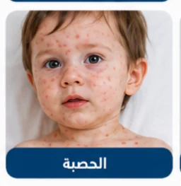 صورة توضيحية: جدري الماء