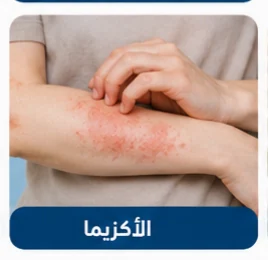 صورة توضيحية: الأكزيما