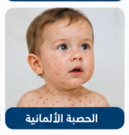 صورة توضيحية: الحصبة الألمانية